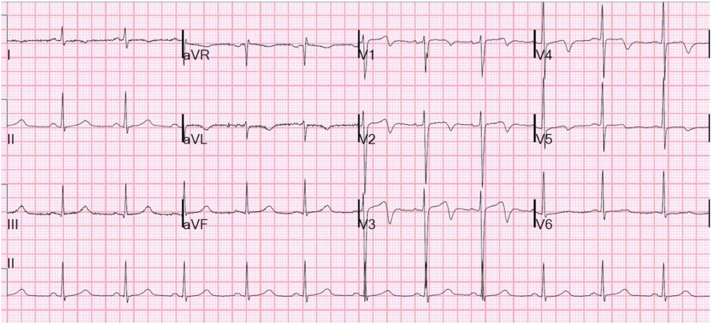 Abnormal EKG