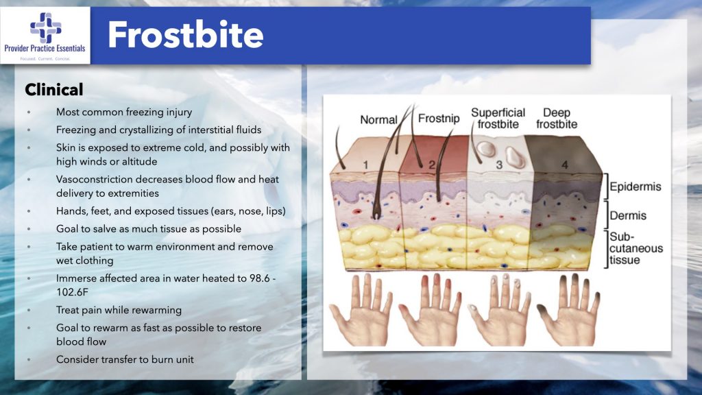 Frostbite
