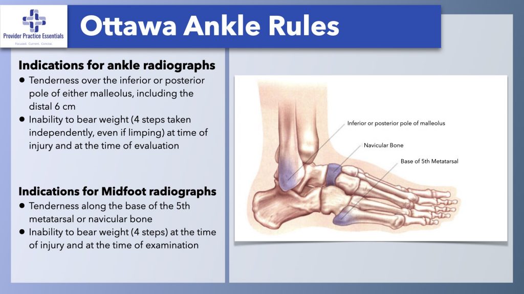 Ottawa Ankle Rules