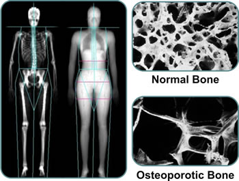 Normal bone versus osteoporotic bone