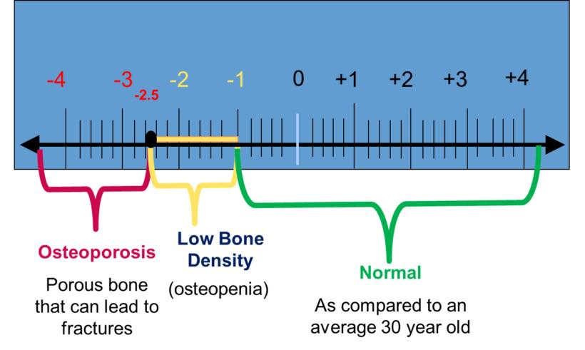 T-Scores for osteoporosis