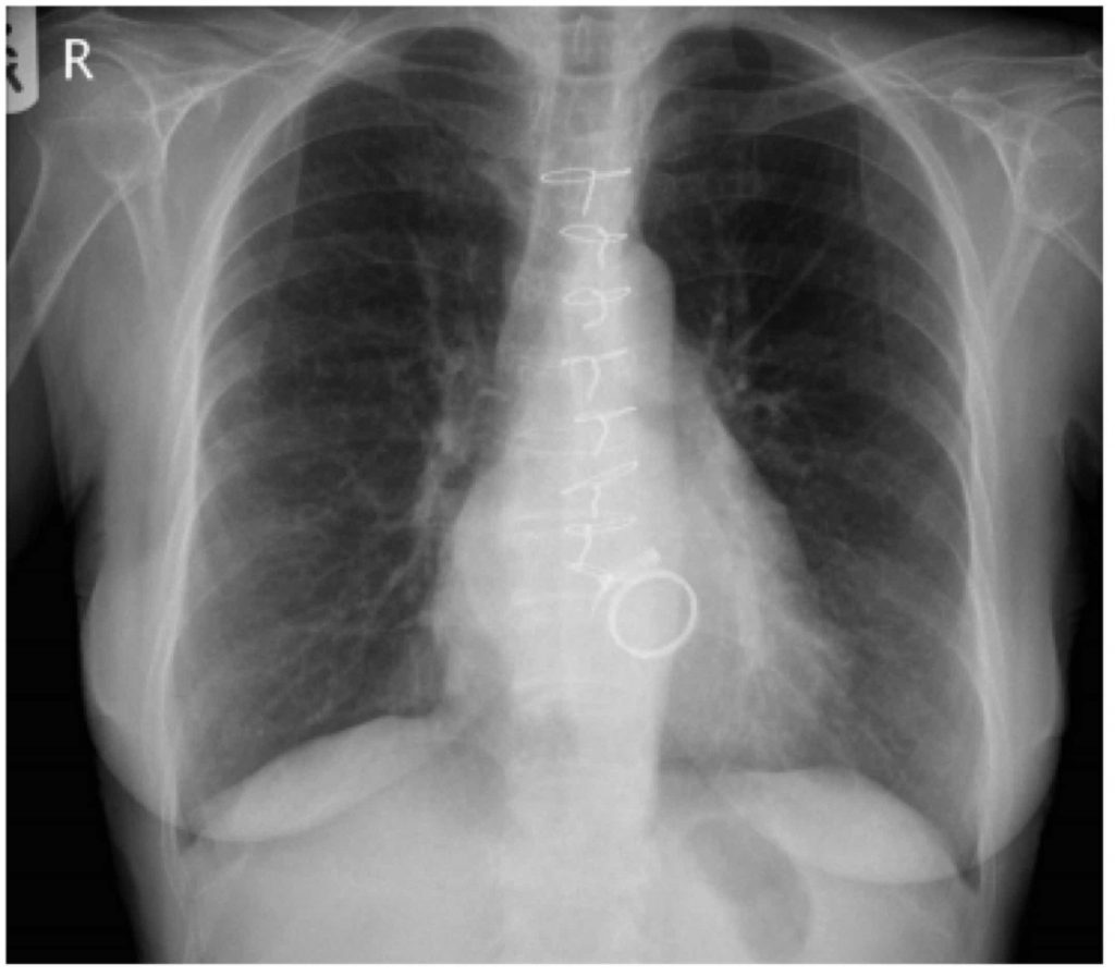 Aortic Valve Replacement