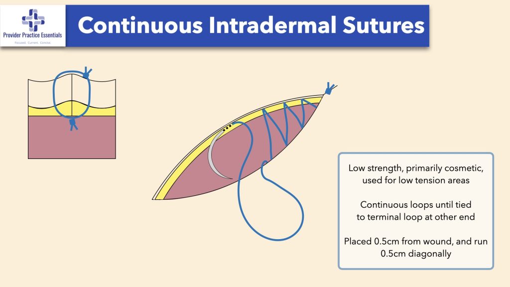 continuous Intradermal Sutures