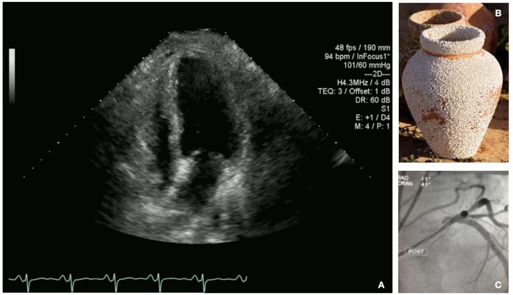 Takatsubo cardiomyopathy